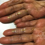 リウマチや膠原病・ばね指 の痛みや指の曲がり・動きを調整して痛みを緩和する研究事例